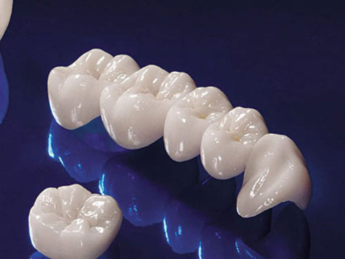 Sự khác biệt của răng sứ không kim loại Cercon